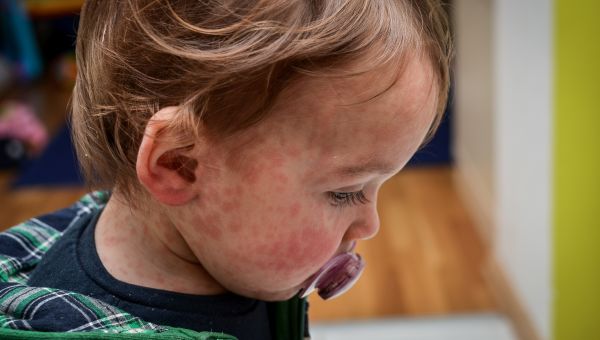 young child with measles rash