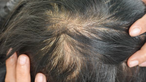woman with thinning hair