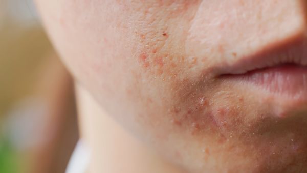closeup of acne on chin and cheek