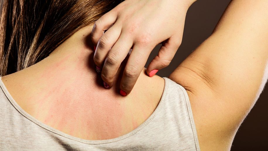 rash, scratching, itching, back, woman, fingernails