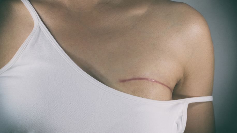 Scar from breast surgery