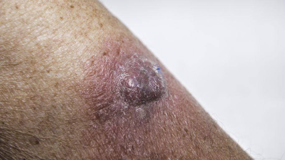 raised squamous cell carcinoma