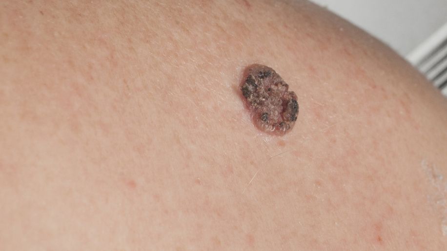 What Does Skin Cancer Really Look Like Cancer Sharecare