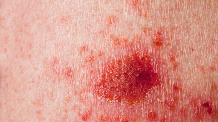 dry patchy basal cell carcinoma