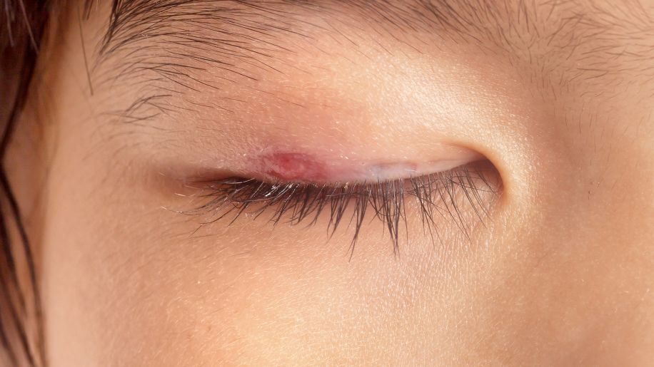 Close up of a red lump on an eyelid.