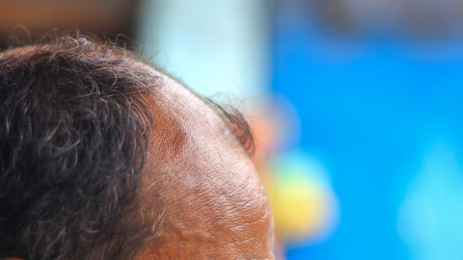 A man's scalp is sunburnt. The scalp is a possible location for skin cancer.