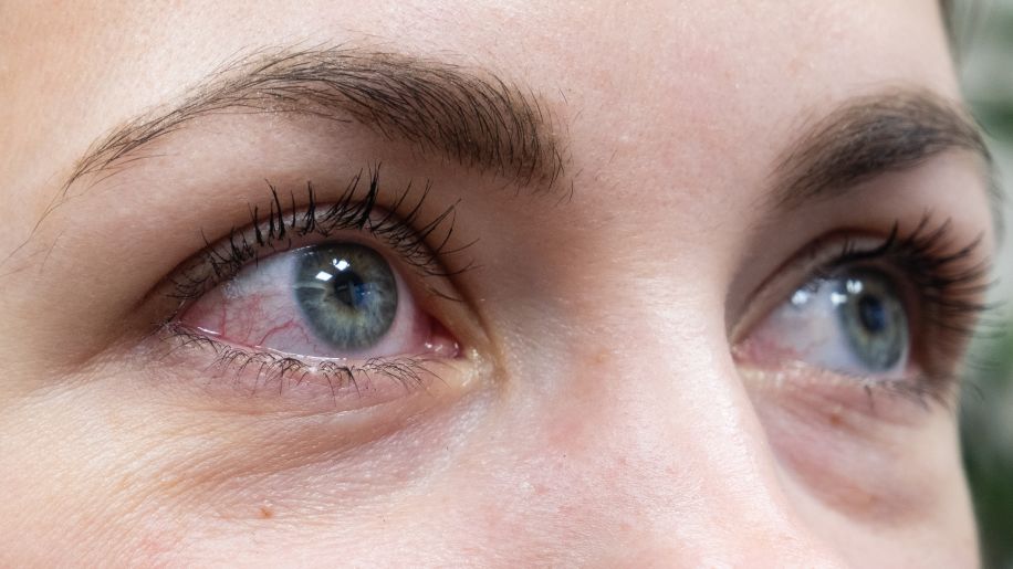 Close up of a woman's very red and irritated eyes.