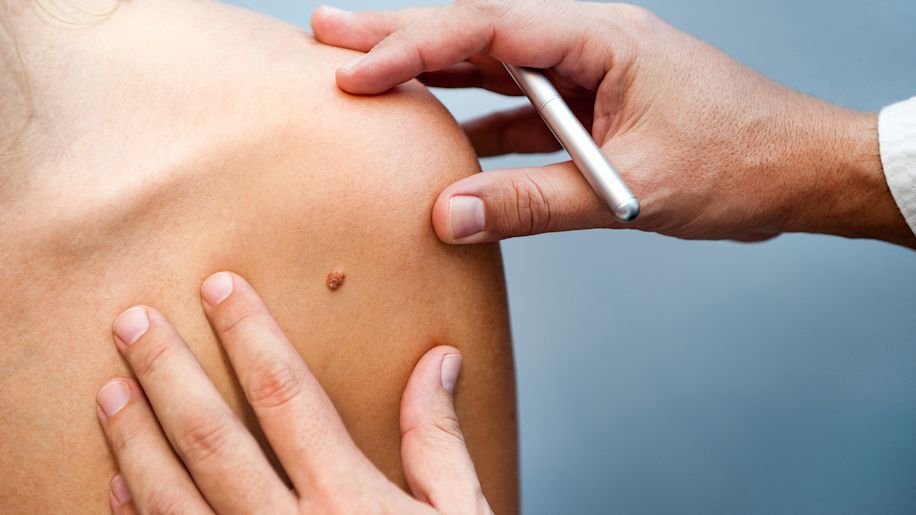 Doctor checks patient for skin cancer.