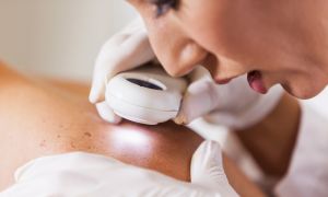 What You Need to Know About Skin Cancer