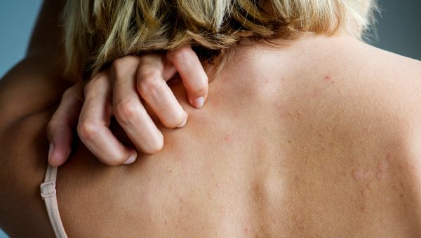 Is It Shingles Psoriasis Or Something Else Sharecare