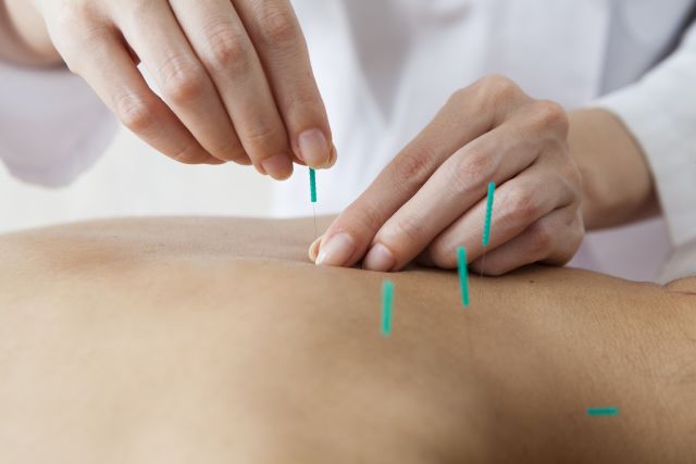 patient getting acupuncture