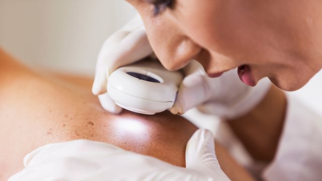 dermatologist checking moles