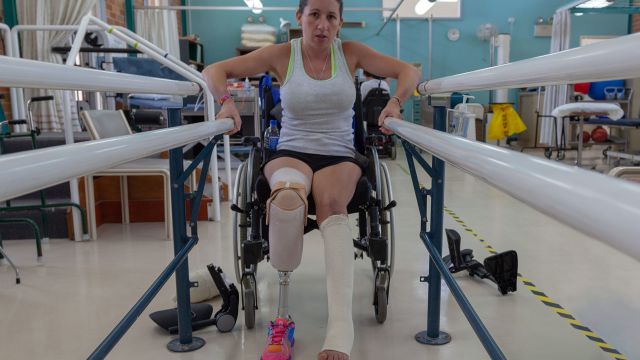 A young woman recovers from a leg amputation. Surgical amputation is one possible outcome for patients with meningococcal disease.