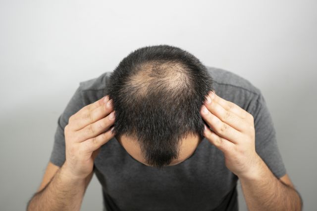 bald, balding, bald head, hair loss, male pattern baldness