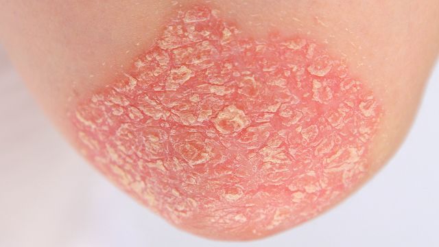 A close-up of a plaque psoriasis lesion on an elbow. The outside of the elbows is a common site for plaque psoriasis.