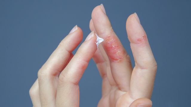 Eczema on woman's hands 