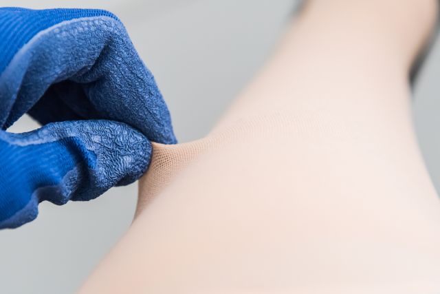 If you have thyroid dermopathy, a healthcare provider might prescribe topical steroids and recommend that you wear compression stockings.