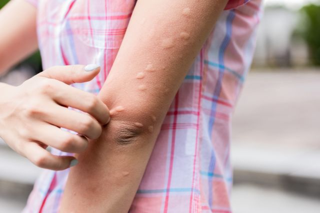 A woman scratches hives on her arms. Research supports the idea that the immune system plays an important role why some people experience chronic hives.