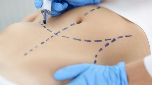 Surgeon marking guidelines with a marker on a patient's abdomen just before weight loss surgery.