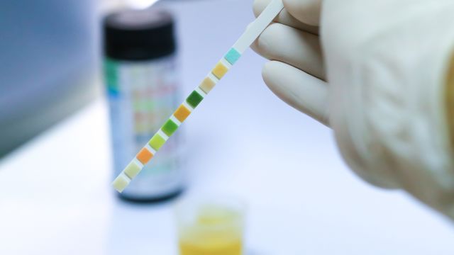 A urine sample being analyzed in a lab for signs of bladder cancer.