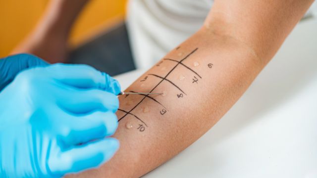 A young adult is tested for food allergies using a skin prick test on the forearm.