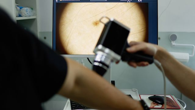A healthcare provider examines a cancerous growth on a patient's arm using a dermatoscope.