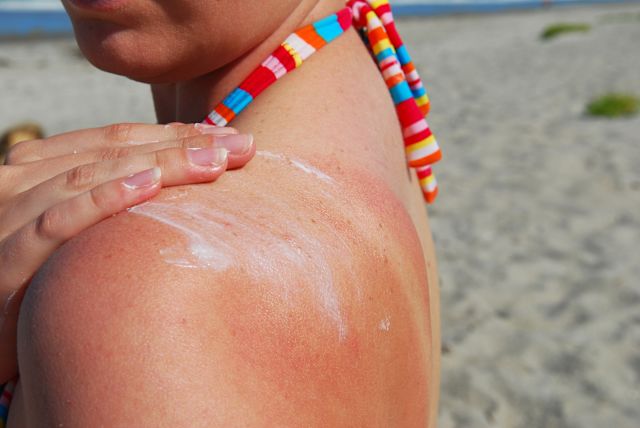 closeup of a woman's sunburned back as she applies sunscreen at the beach 
