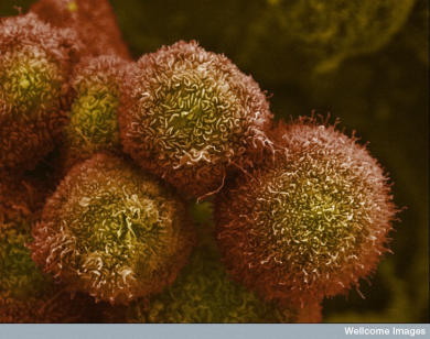 Pancreatic cancer cells. Picture: Wellcome Images.