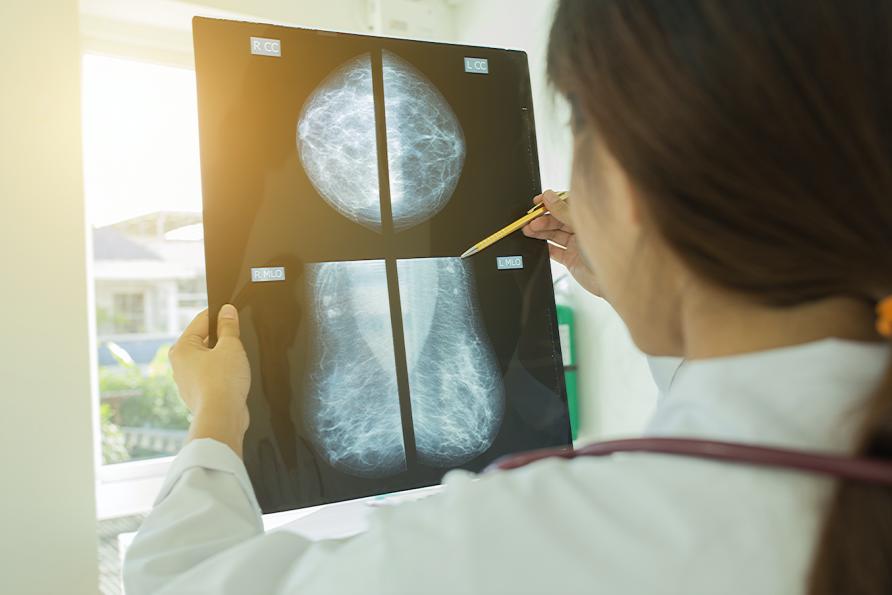 Predicting Cancer Risk From Mammograms Could Revolutionise Screening